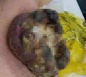 化疗|上海肿瘤医院请选择广州复大肿瘤医院：救治巨大乳腺癌患者