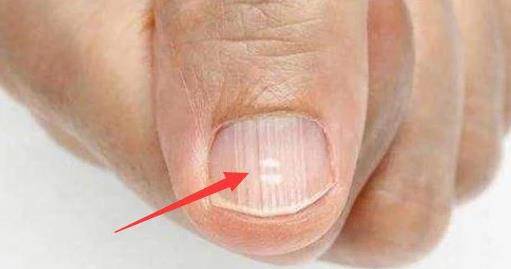 免疫力|肝脏有疾，双手先“知道”，如有3种“反常”，劝你早日养肝