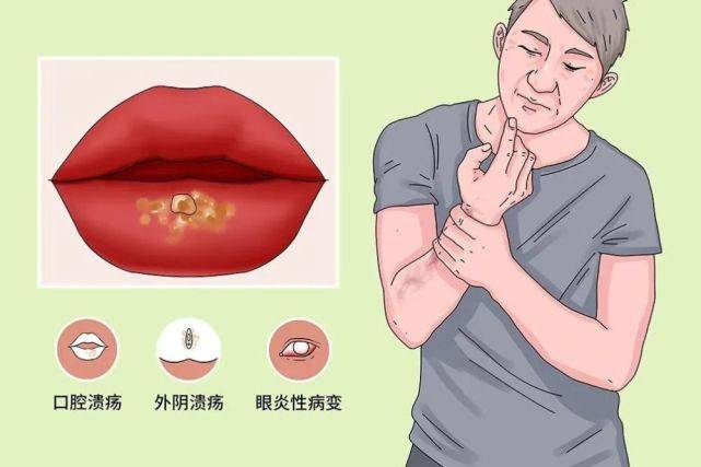 白塞病发作后会出现哪些症状_患者_治疗_病变