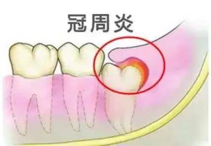 口腔科普智齿冠周炎的诊断与预防