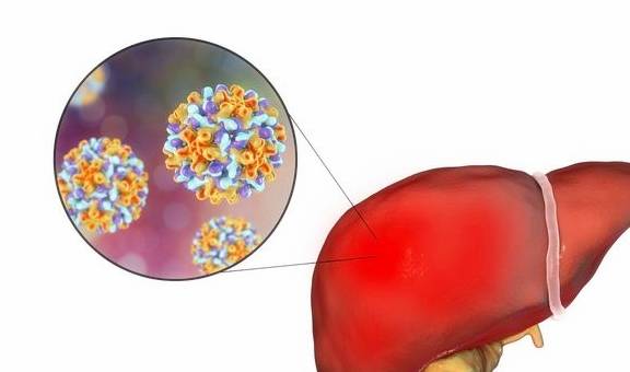 免疫力|乙肝病毒携带者可以活多长时间？你的理解真的对吗？看专家的理解