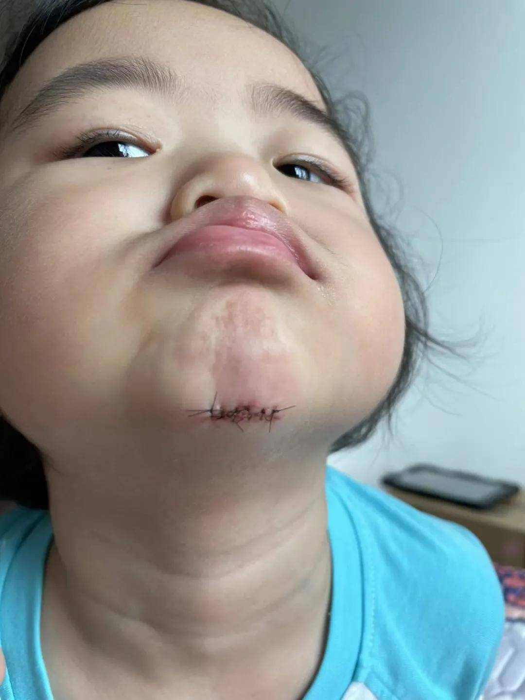 下巴|揪心！“1岁多女儿在新加坡幼儿园受伤缝6针，学校的态度令人心寒……”