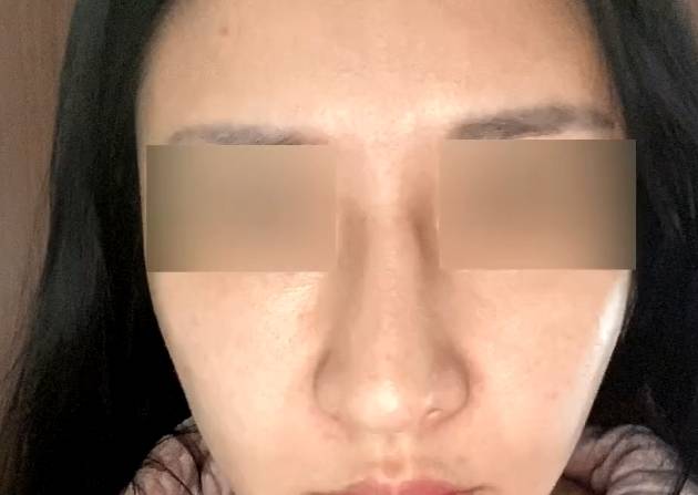 鼻子一侧骨头突出图片 搜狗图片搜索