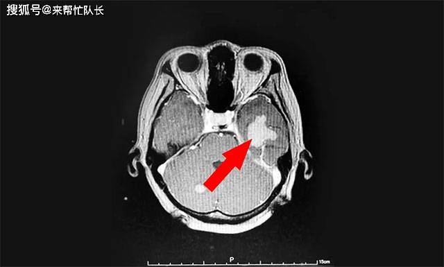 症状|食欲不振、消瘦、肚子却莫名变大，发现肝腹水还能活多久？