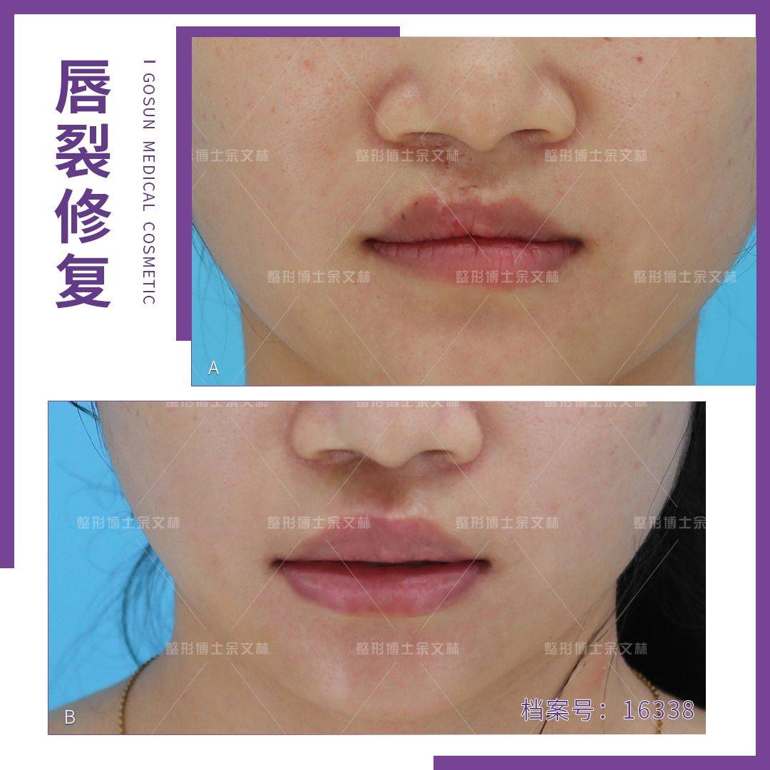 唇裂修复术后唇红缘不齐唇线不明显可不可以修复