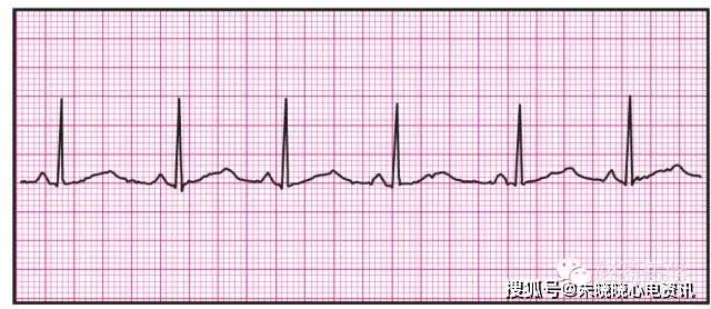 常見心電圖圖文參考