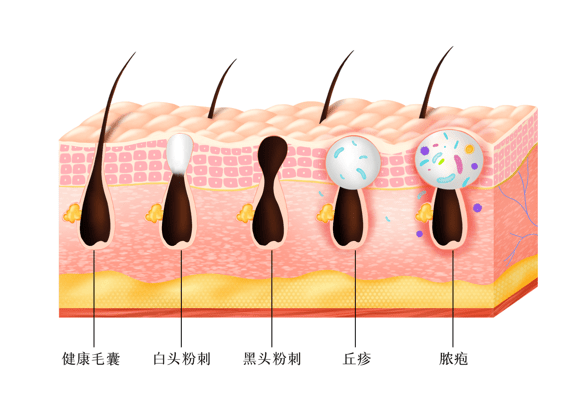 有黑头了怎么办