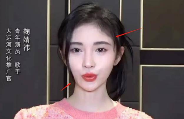 演技鞠婧祎陷整容争议？面部极不自然，发际线粉明显，网友直呼认不出