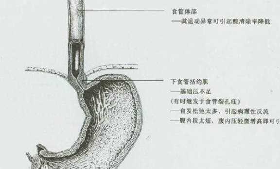 括约肌|胃食管反流是因为胃酸太多导致的吗？那么该怎么办呢？