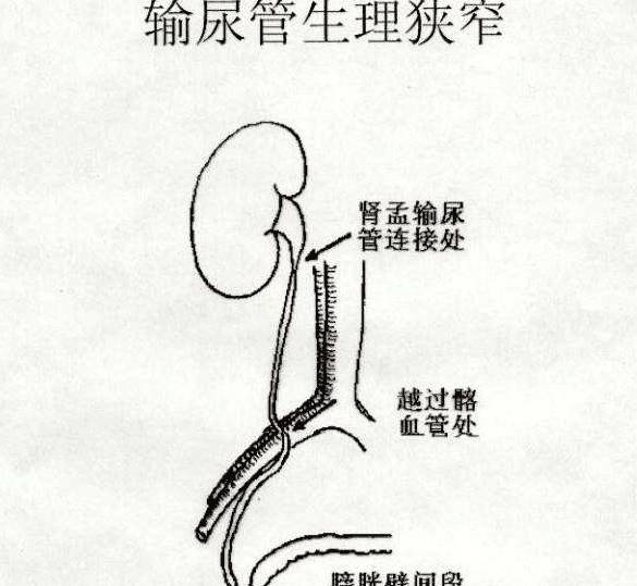 人体|「创作开运礼」多喝水排结石，为啥我喝了很多水，却依旧排不出？