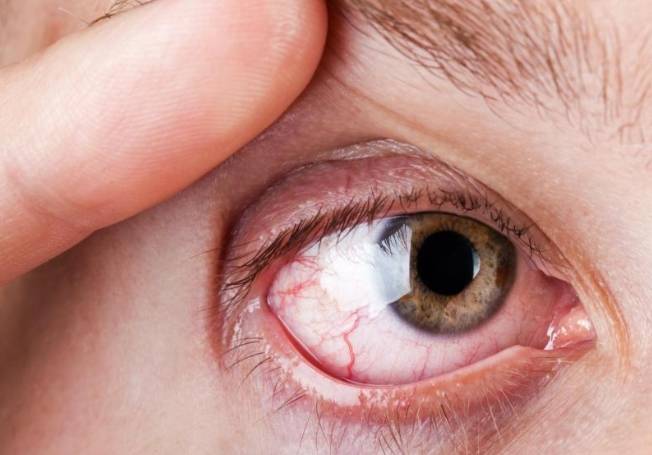 为什么眼睛里有红血丝？或许和3个原因有关，第二个可能你正在做