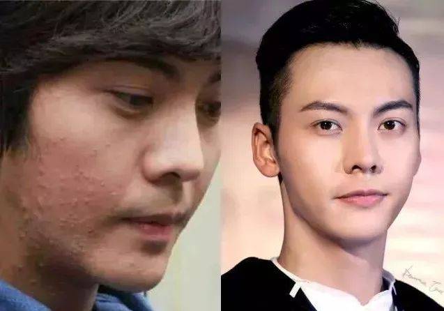长痘痘银幕上的明星们为什么肌肤那么光洁？