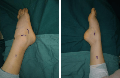 先为她进行了"右马蹄高弓内翻足畸形矫正术",术中进行跟腱,跖筋膜松解