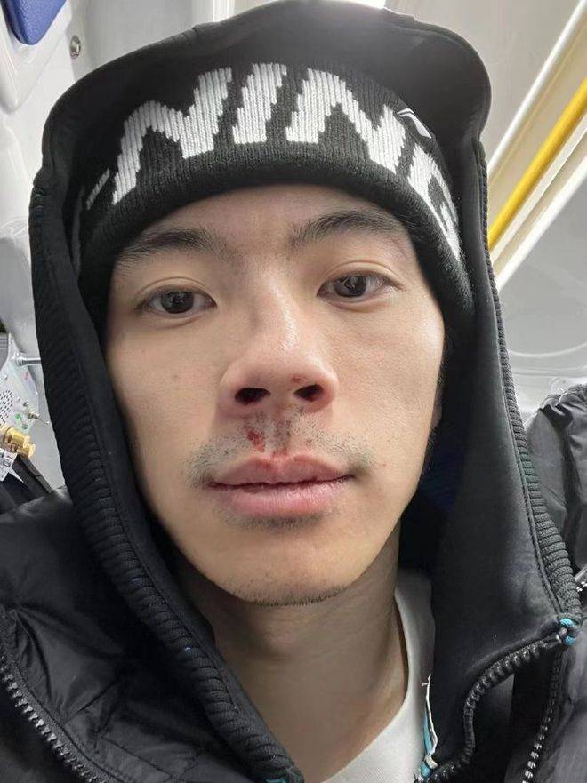 同曦王子瑞鼻骨骨折需要手术球队雪上加霜