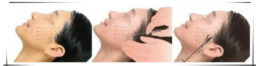 新风新风口:线雕20天后脸上有凹陷?线雕凹陷快速处理办法?别懵了~