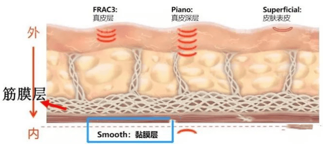 美容|Fotona4D美容 云南铜雀台杨才华讲解Fotona 4D Pro
