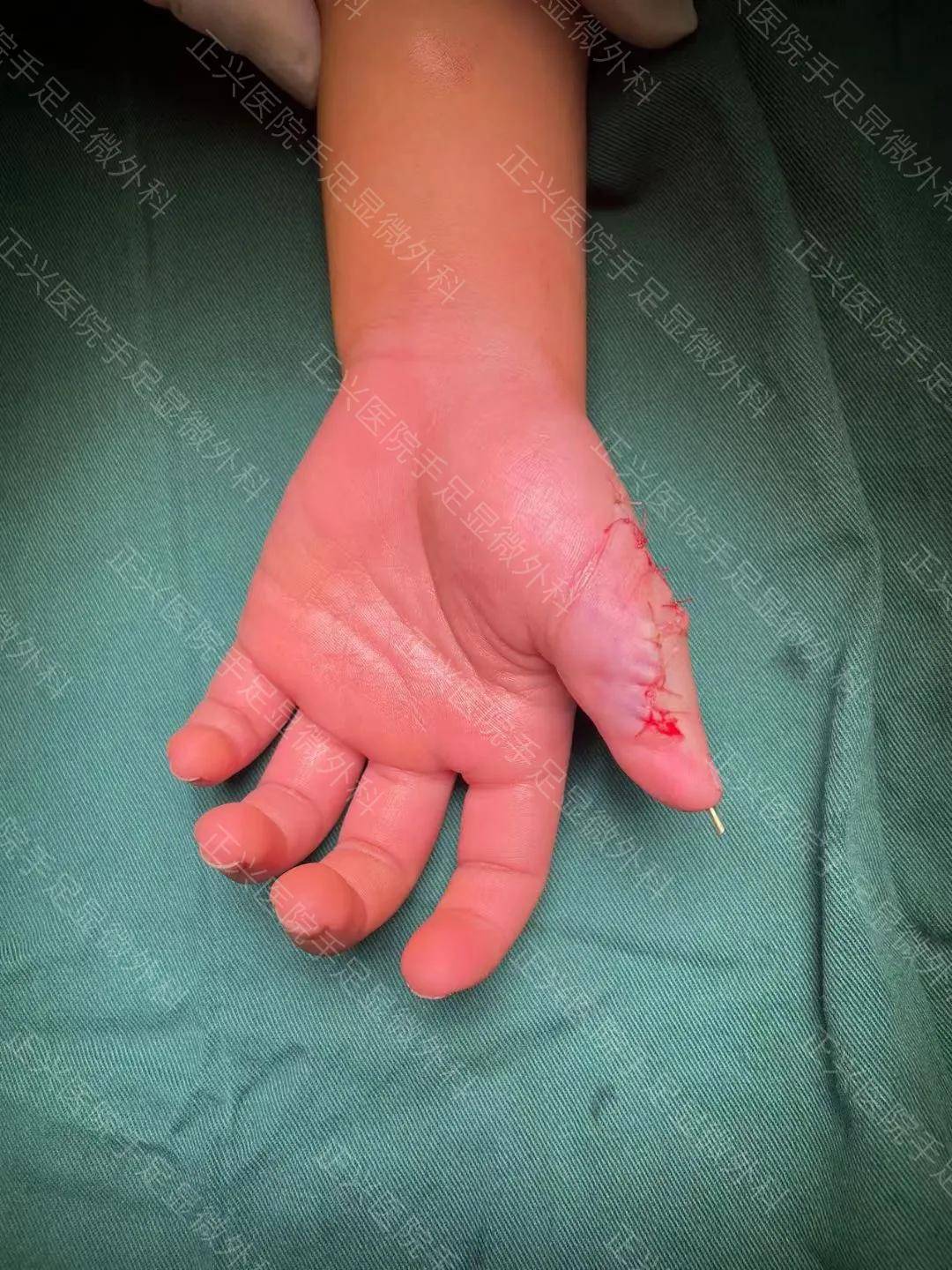 六指症手术图片