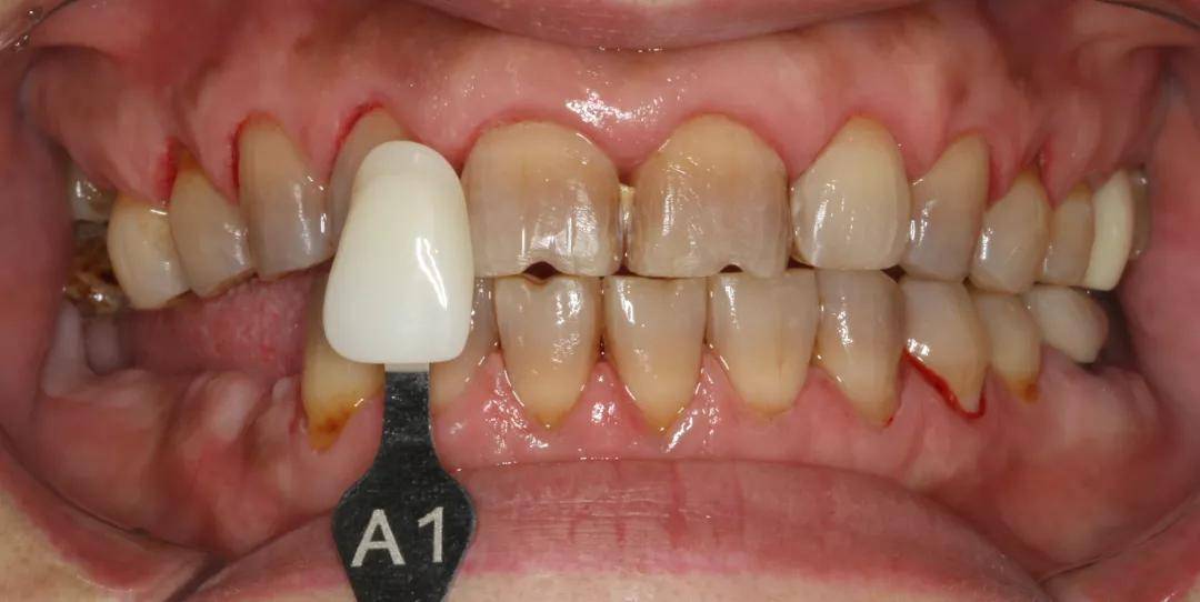 绚彩3d pro临床病例展示丨氧化锆贴面治疗四环素牙一例