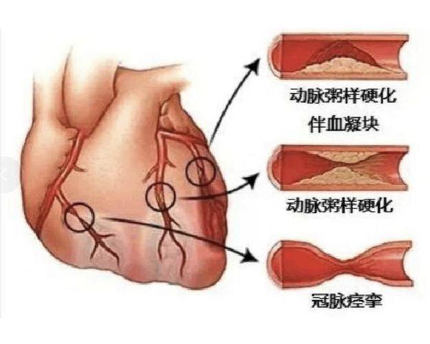 我們平常說的心肌缺血,其實可以簡單地理解為就是冠心病.