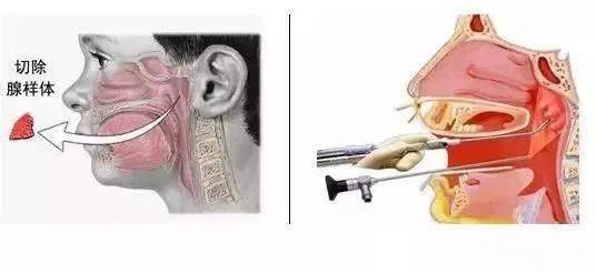 【寒假特辑】扁桃体,腺样体肥大,割还是不割?_手术_孩子_医生