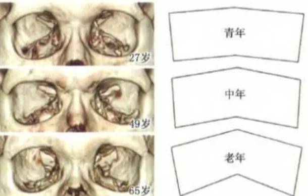 来判断根据眼眶结构来判断和修正自己的眼部光影美感