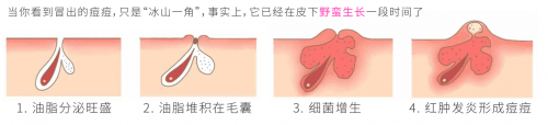 祛痘高加斯探索科技祛痘领域，提出祛痘新主张