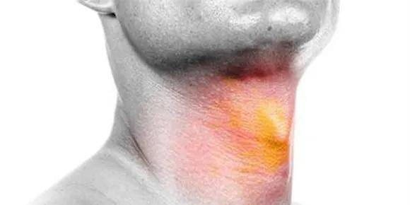 比如荨麻疹来了,手上有风团,腿上有风团,突然间你的喉头水肿了,这种