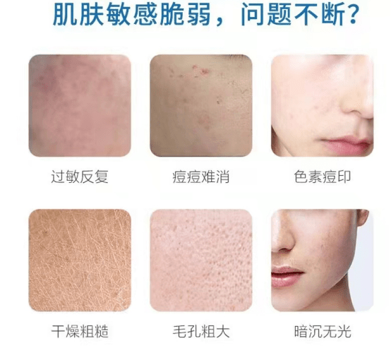 表皮层你有“肌肤节后综合症”吗？