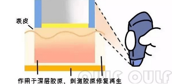 能量超声刀美容恢复期多久？扒皮超声刀美容适合年龄？你中招了吗？