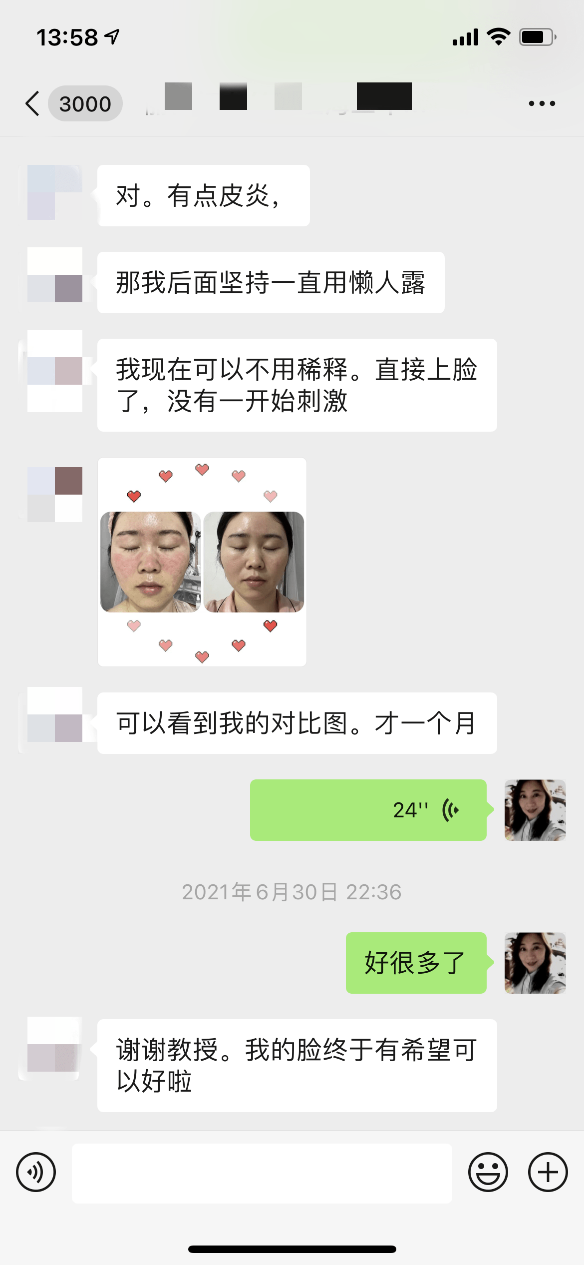 脸部玫瑰痤疮（红血丝、激素脸）— 终于可以和你说再见