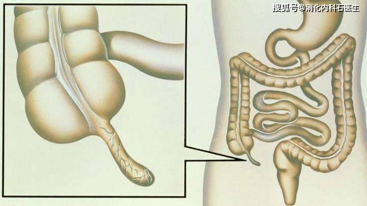 复查|男人腹痛剧烈，阑尾切除痛却加重，医生：这是一种会愚弄人的病！