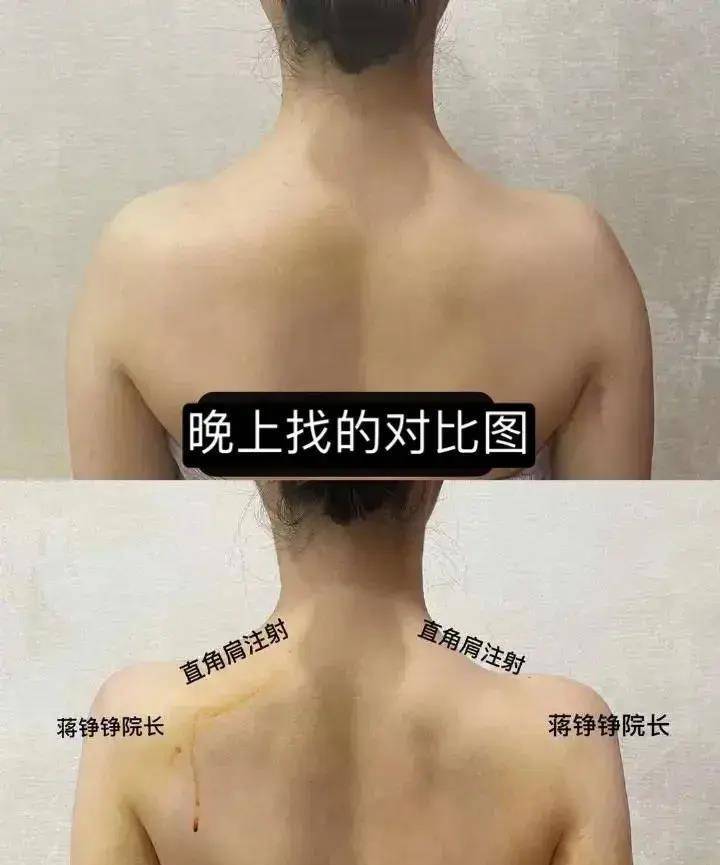 直角鞠婧祎罕见无刘海照曝光！用玻酸注射肩膀？为了美也太狠了
