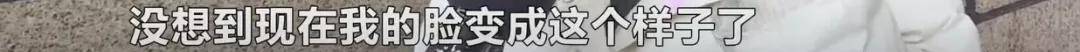 维权长沙一女子花5000元祛斑后懊恼被“毁容”，工作人员：正常现象