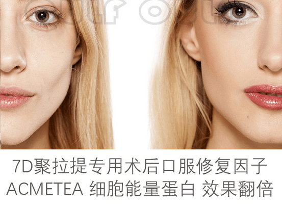 mm爆：4d和7d聚拉提有什么区别？7d聚拉提大概全脸下来多少米？