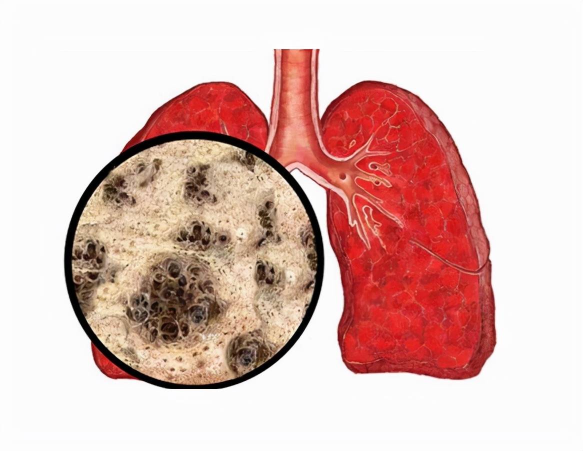 查出肺结节的人越来越多,问题出在哪?喝什么水,有利散结?