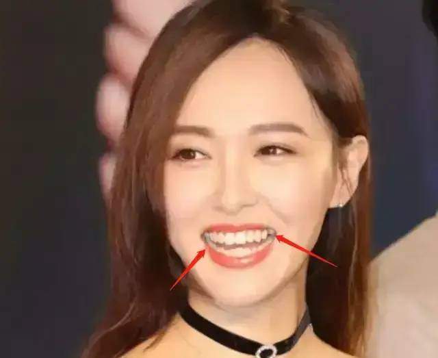 脸部明星整牙后遗症：杨幂脸部松弛，王嘉尔颧骨外扩，宋祖儿法令纹深
