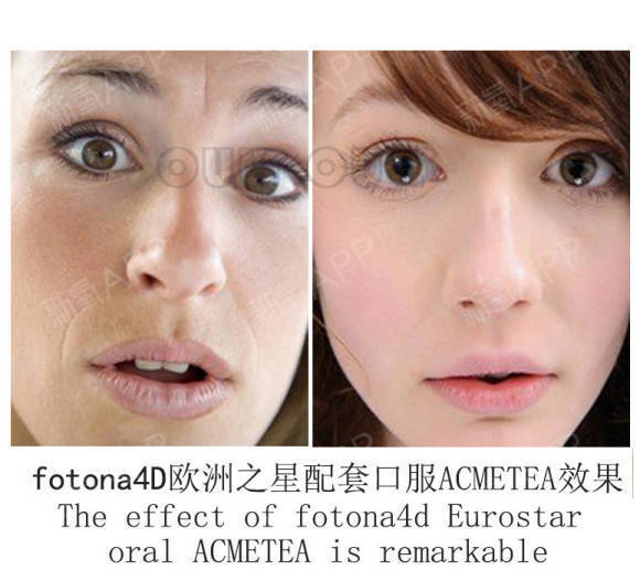 才有关于fotona4d做一次维持多久？fotona 4d效果维持多久做过了才有话说