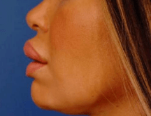 梅尔国际快讯 | 过度的使用注射剂后,你的笑容会被改变吗?