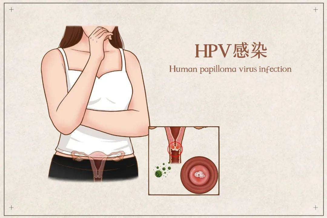 那么,出现哪些症状需警惕hpv感染?男性可以接种hpv疫苗吗?