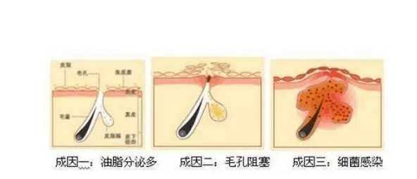 毛孔脸上长闭口和红痘痘要怎么护理才好，敬修堂佰花方靠谱吗！