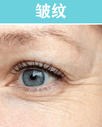 产品干纹细纹和皱纹的区别？怎么去除干纹细纹皱纹的小妙招（配图）