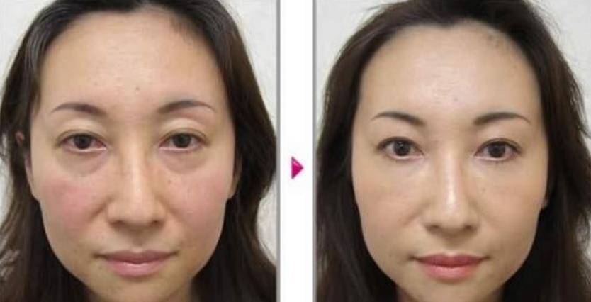 戚薇36岁佟丽娅老成这样?黑眼袋严重吓坏众人,粉丝:丫丫擦下眼霜吧