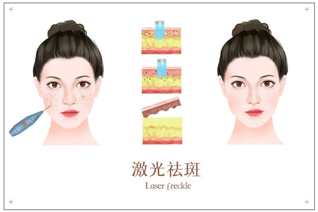 玛吉三个医美项目：水光针、光子嫩肤、热拉提