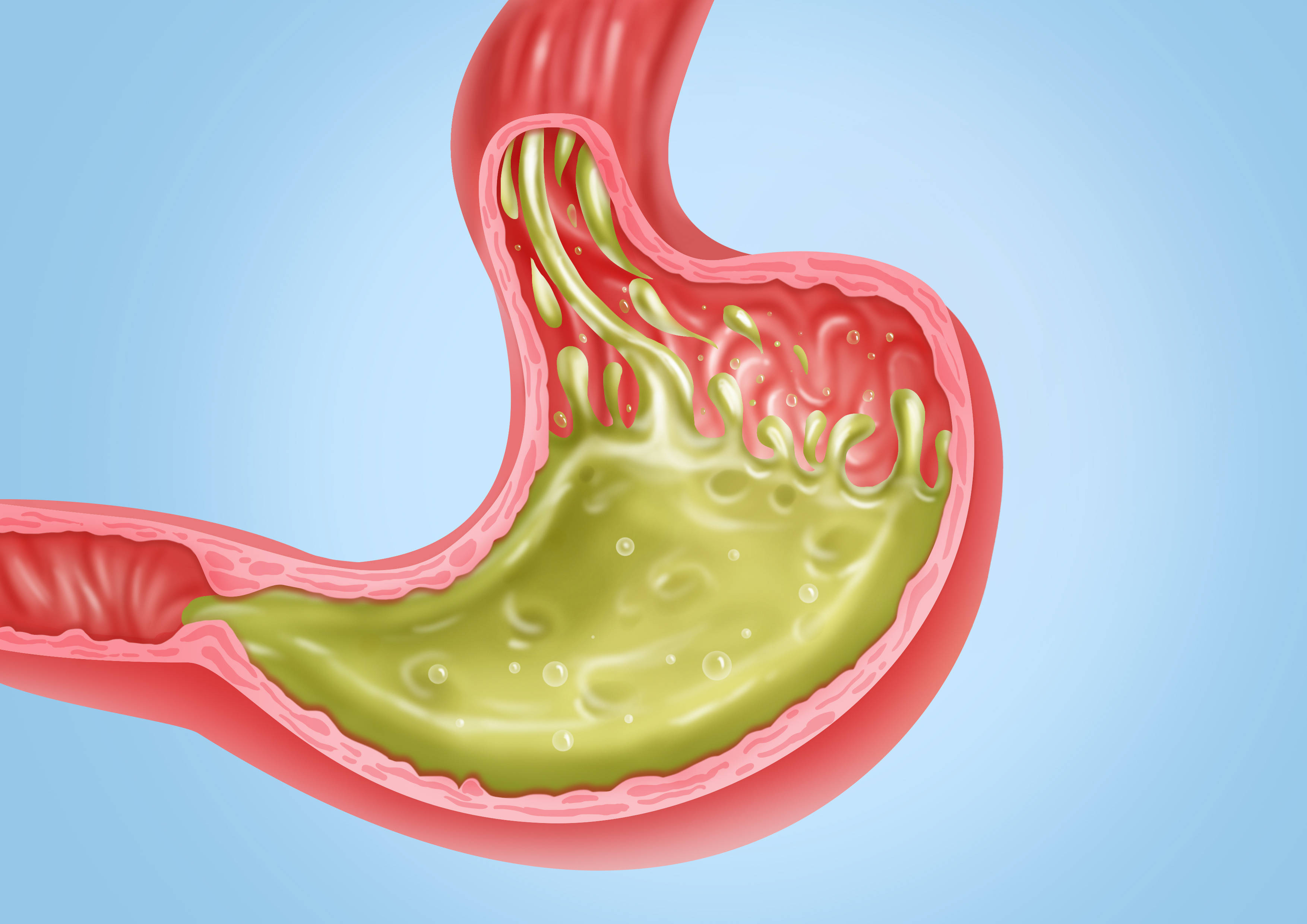 混合物_胃液_食物