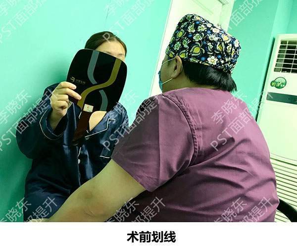 李主任36岁的黄女士，用她的亲身经历告诉你：面部提升的效果怎么样？