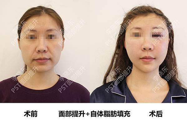 李主任36岁的黄女士，用她的亲身经历告诉你：面部提升的效果怎么样？