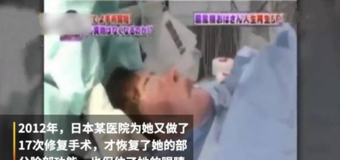 因为女星韩慧景：为了更漂亮，给脸注射食用油，把脸整成“猪头”