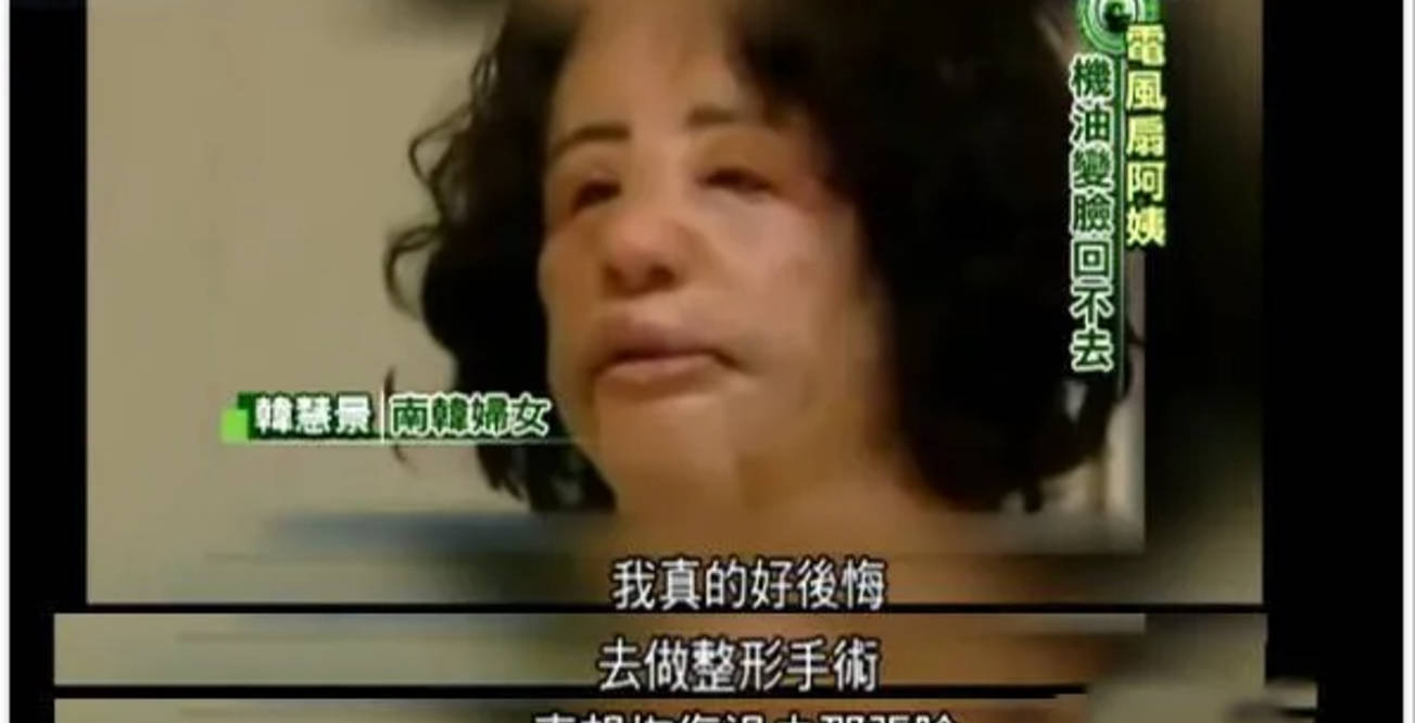 因为女星韩慧景：为了更漂亮，给脸注射食用油，把脸整成“猪头”