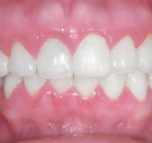 警惕牙龈线后退比发际线后退还要毁颜值