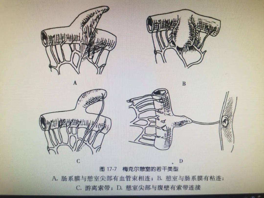 乙状窦憩室手术图片